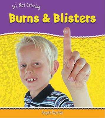 It's Not Catching: Burns And Blisters Hardback