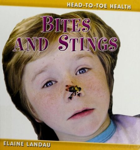 Bites and Stings