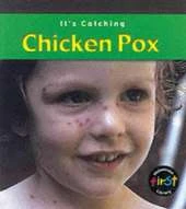 It's Catching: Chicken Pox Paperback